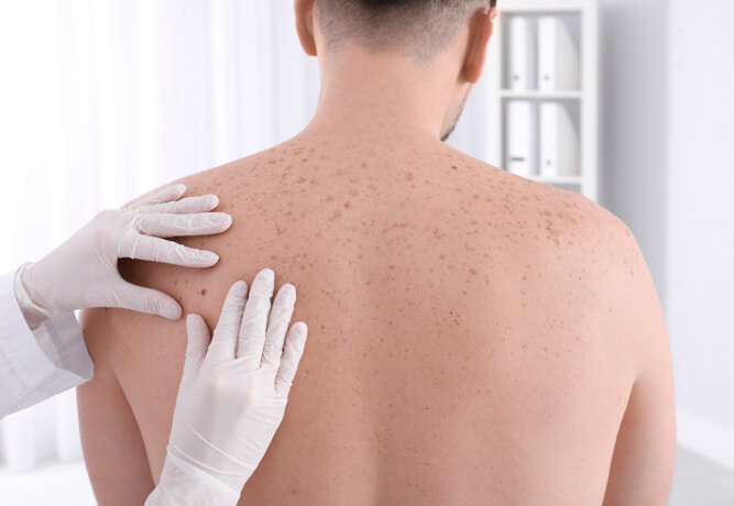 Médico examinando lunares en espalda para prevenir el cáncer de piel.