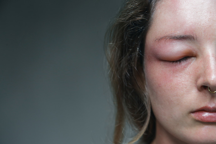 Mujer con reacción alérgica tras una picadura de avispa en la cara
