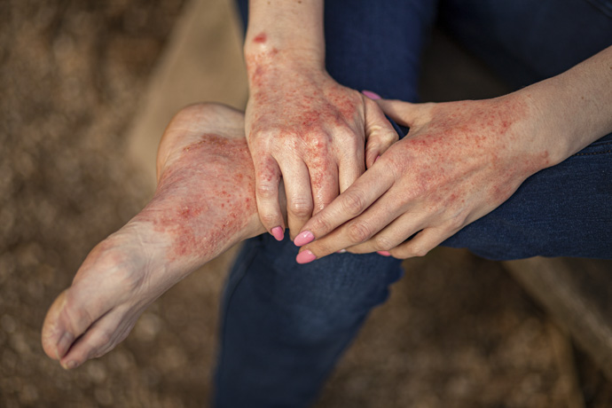 Mujer con manchas rojas en los pies y las manos