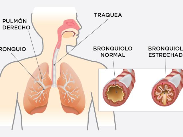 Sistema respiratorio - EPOC